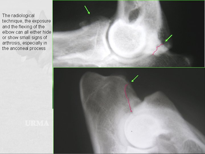 The radiological technique, the exposure and the flexing of the elbow can all either