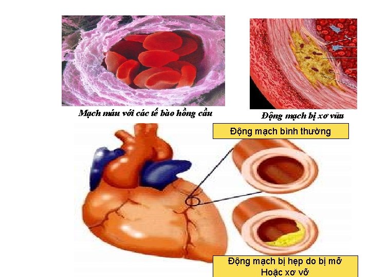 Mạch máu với các tế bào hồng cầu Động mạch bị xơ vữa Động