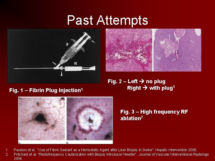 Past Attempts Fig. 1 – Fibrin Plug Injection 1 Fig. 2 – Left no