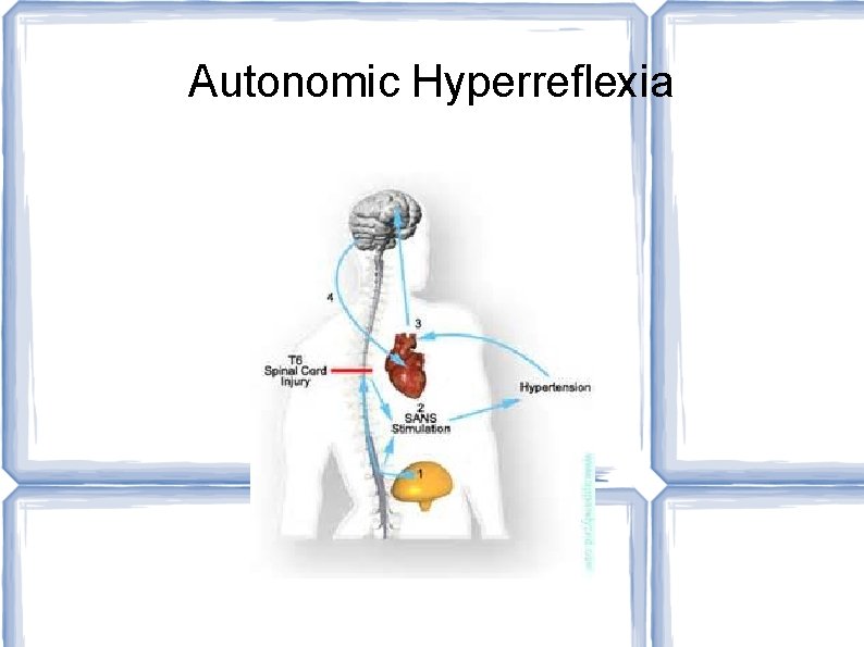 Autonomic Hyperreflexia 