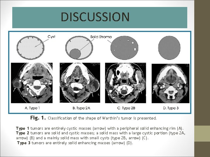 DISCUSSION Fig. 1. Classification of the shape of Warthin’s tumor is presented. Type 1