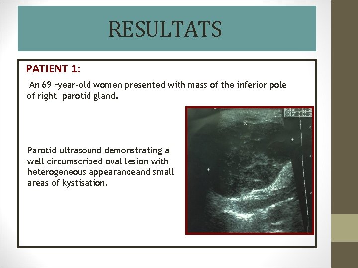 RESULTATS PATIENT 1: An 69 –year-old women presented with mass of the inferior pole