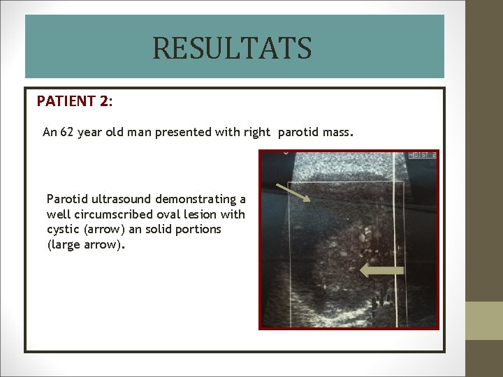 RESULTATS PATIENT 2: An 62 year old man presented with right parotid mass. Parotid