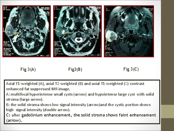 Fig 3(A) Fig 3(B) Fig 3(C) Axial T 1 -weighted (A), axial T 2