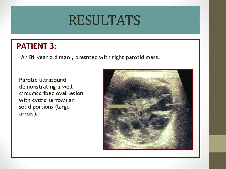 RESULTATS PATIENT 3: An 81 year old man , presnted with right parotid mass.