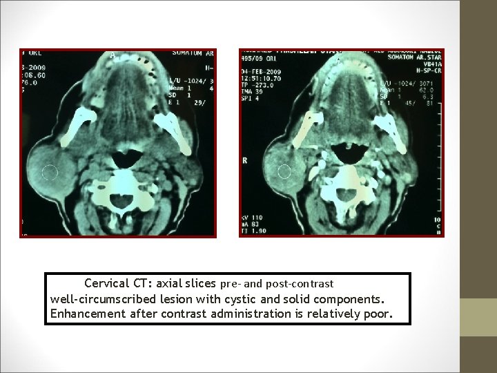 Cervical CT: axial slices pre- and post-contrast well-circumscribed lesion with cystic and solid components.