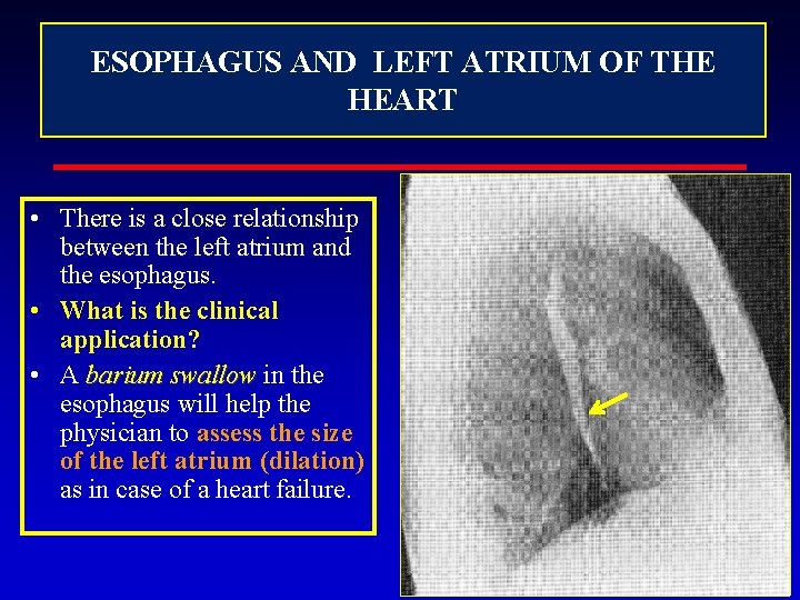 ESOPHAGUS AND LEFT ATRIUM OF THE HEART • There is a close relationship between