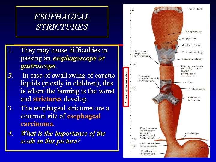 ESOPHAGEAL STRICTURES 1. They may cause difficulties in passing an esophagoscope or gastroscope. 2.