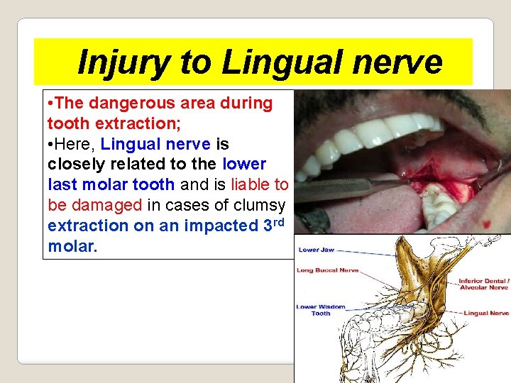 Injury to Lingual nerve • The dangerous area during tooth extraction; • Here, Lingual