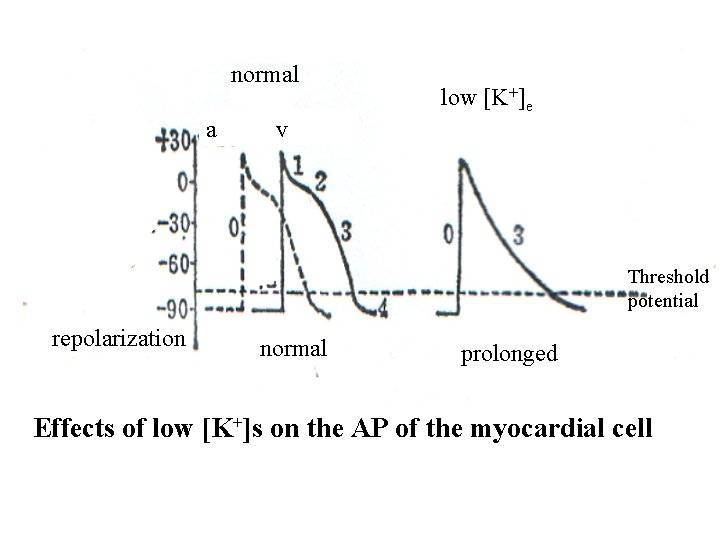 normal a low [K+]e v Threshold potential repolarization normal prolonged Effects of low [K+]s