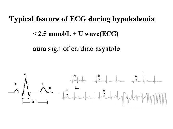 Typical feature of ECG during hypokalemia < 2. 5 mmol/L + U wave(ECG) aura