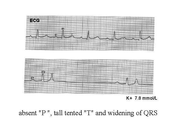 ECG K+ 7. 8 mmol/L absent "P ", tall tented "T" and widening of