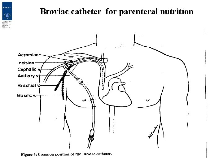 Broviac catheter for parenteral nutrition 