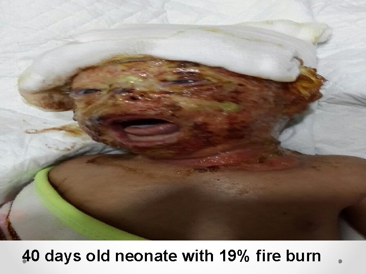 40 days old neonate with 19% fire burn 