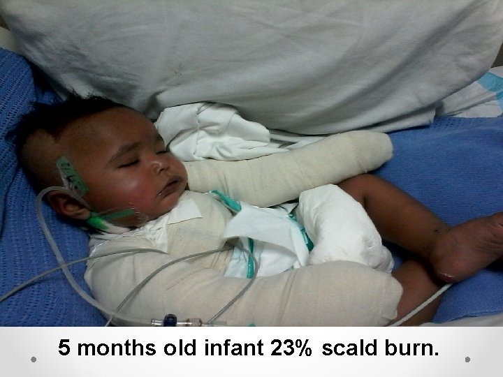 5 months old infant 23% scald burn. 