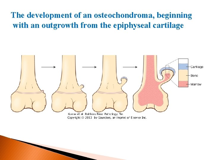 The development of an osteochondroma, beginning with an outgrowth from the epiphyseal cartilage 