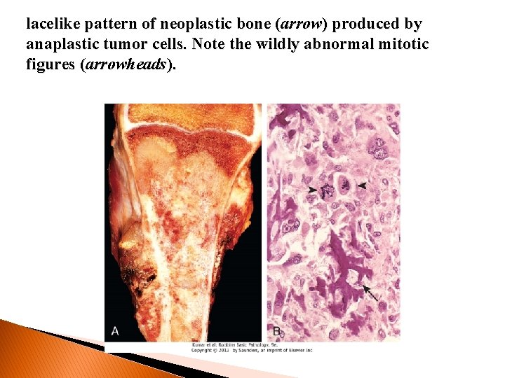 lacelike pattern of neoplastic bone (arrow) produced by anaplastic tumor cells. Note the wildly