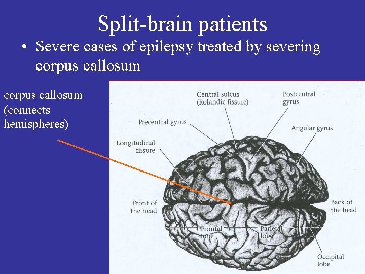 Split-brain patients • Severe cases of epilepsy treated by severing corpus callosum (connects hemispheres)