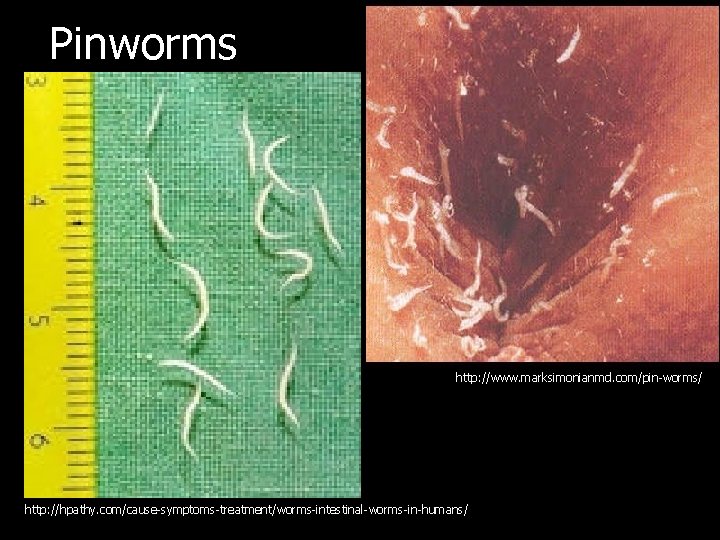 Pinworms http: //www. marksimonianmd. com/pin-worms/ http: //hpathy. com/cause-symptoms-treatment/worms-intestinal-worms-in-humans/ 