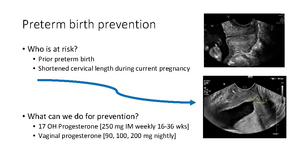 Preterm birth prevention • Who is at risk? • Prior preterm birth • Shortened