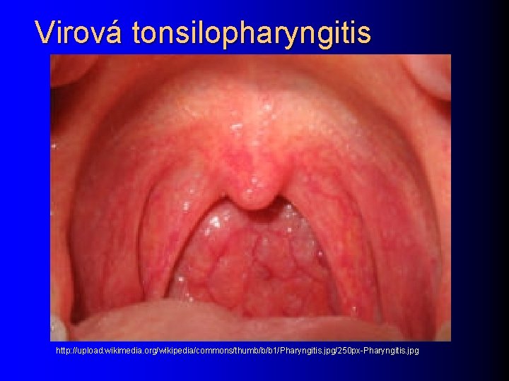 Virová tonsilopharyngitis http: //upload. wikimedia. org/wikipedia/commons/thumb/b/b 1/Pharyngitis. jpg/250 px-Pharyngitis. jpg 