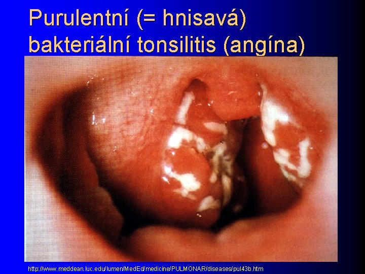 Purulentní (= hnisavá) bakteriální tonsilitis (angína) http: //www. meddean. luc. edu/lumen/Med. Ed/medicine/PULMONAR/diseases/pul 43 b.