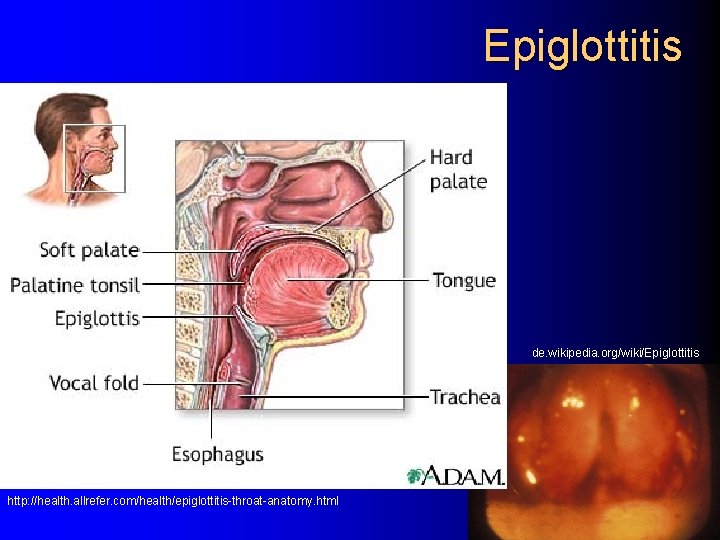 Epiglottitis de. wikipedia. org/wiki/Epiglottitis http: //health. allrefer. com/health/epiglottitis-throat-anatomy. html 