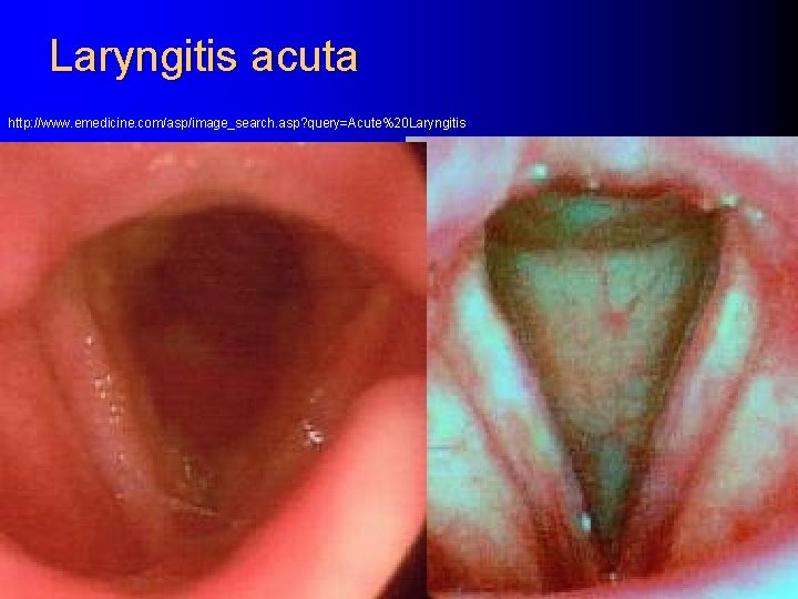 Laryngitis acuta http: //www. emedicine. com/asp/image_search. asp? query=Acute%20 Laryngitis 