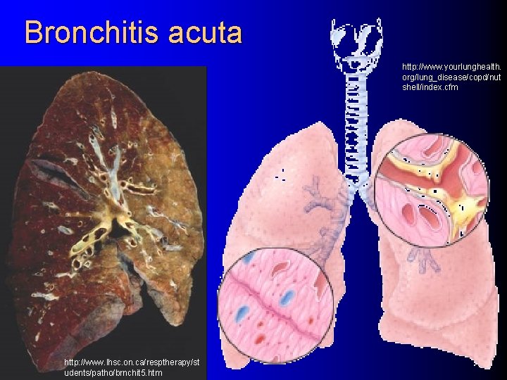 Bronchitis acuta http: //www. yourlunghealth. org/lung_disease/copd/nut shell/index. cfm http: //www. lhsc. on. ca/resptherapy/st udents/patho/brnchit