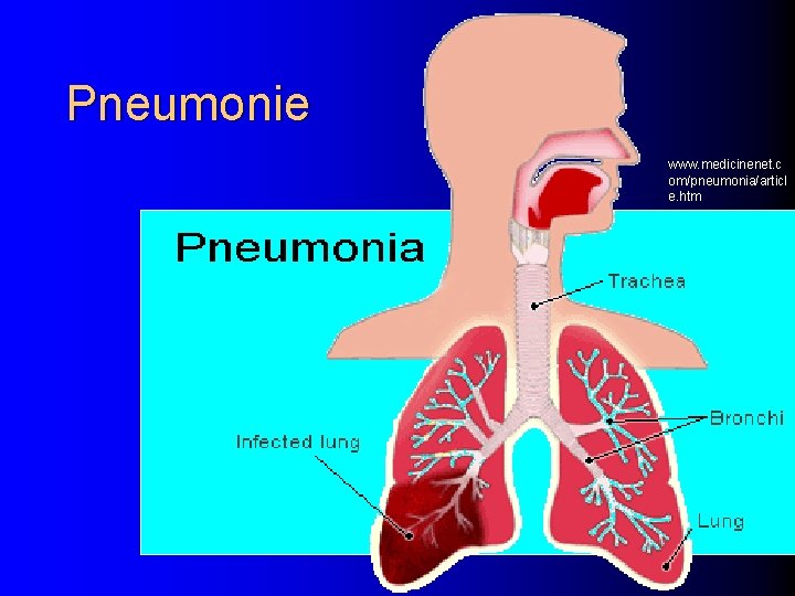 Pneumonie www. medicinenet. c om/pneumonia/articl e. htm 