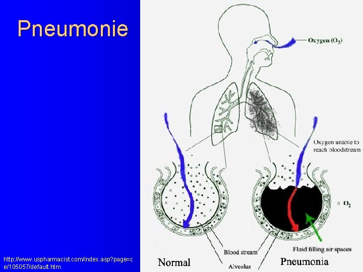 Pneumonie http: //www. uspharmacist. com/index. asp? page=c e/105057/default. htm 