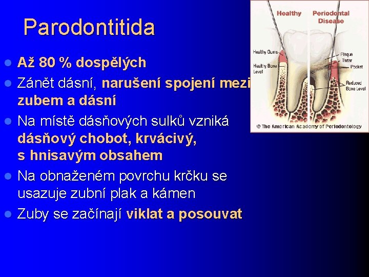 Parodontitida l l l Až 80 % dospělých Zánět dásní, narušení spojení mezi zubem