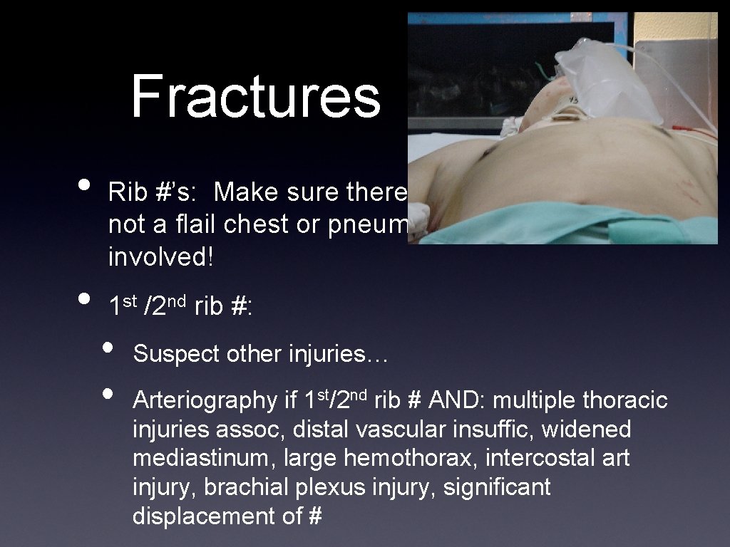 Fractures • • Rib #’s: Make sure there is not a flail chest or