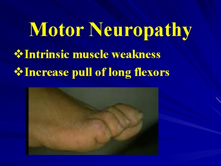 Motor Neuropathy v. Intrinsic muscle weakness v. Increase pull of long flexors 
