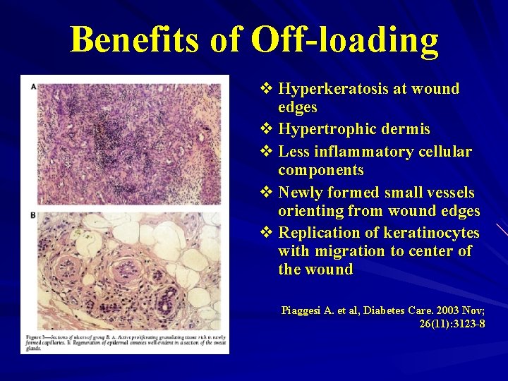 Benefits of Off-loading v Hyperkeratosis at wound edges v Hypertrophic dermis v Less inflammatory