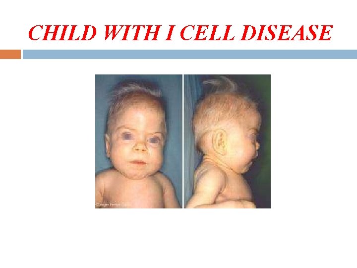 CHILD WITH I CELL DISEASE 