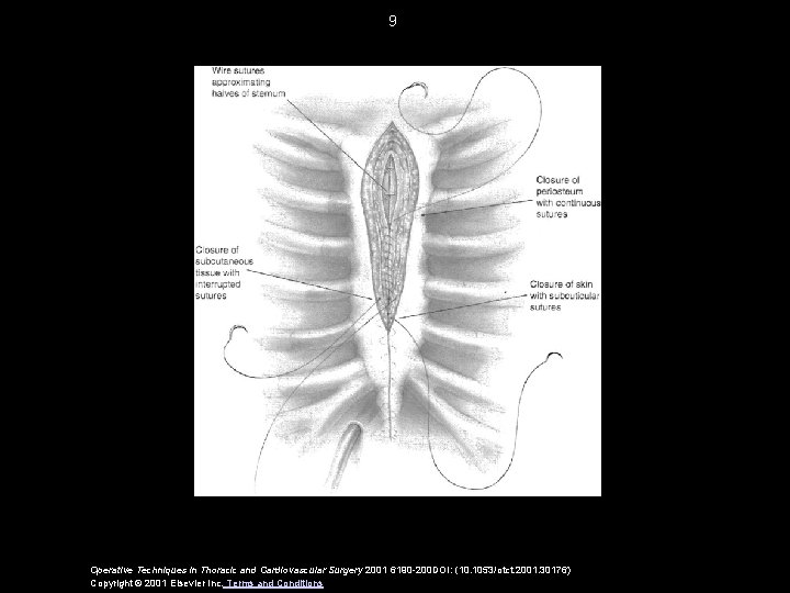 9 Operative Techniques in Thoracic and Cardiovascular Surgery 2001 6190 -200 DOI: (10. 1053/otct.