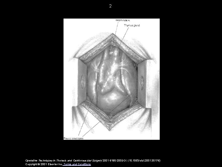 2 Operative Techniques in Thoracic and Cardiovascular Surgery 2001 6190 -200 DOI: (10. 1053/otct.