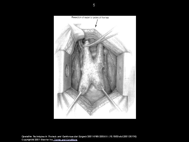 5 Operative Techniques in Thoracic and Cardiovascular Surgery 2001 6190 -200 DOI: (10. 1053/otct.