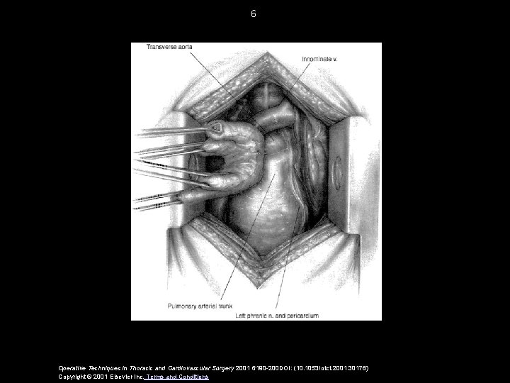 6 Operative Techniques in Thoracic and Cardiovascular Surgery 2001 6190 -200 DOI: (10. 1053/otct.