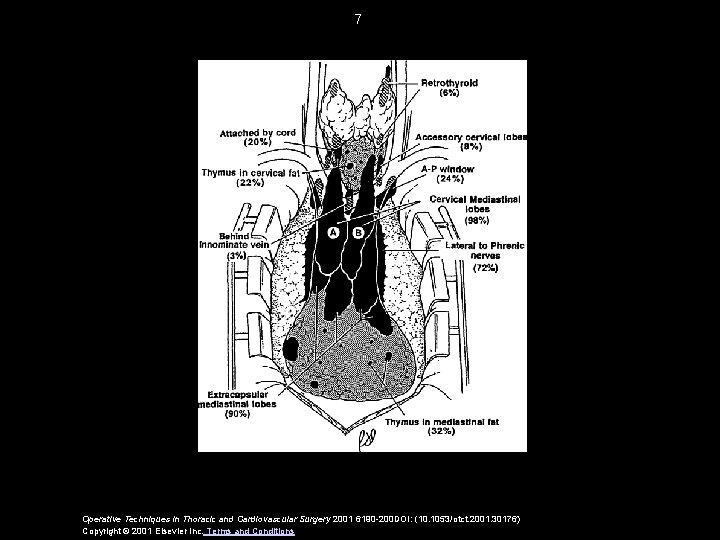 7 Operative Techniques in Thoracic and Cardiovascular Surgery 2001 6190 -200 DOI: (10. 1053/otct.