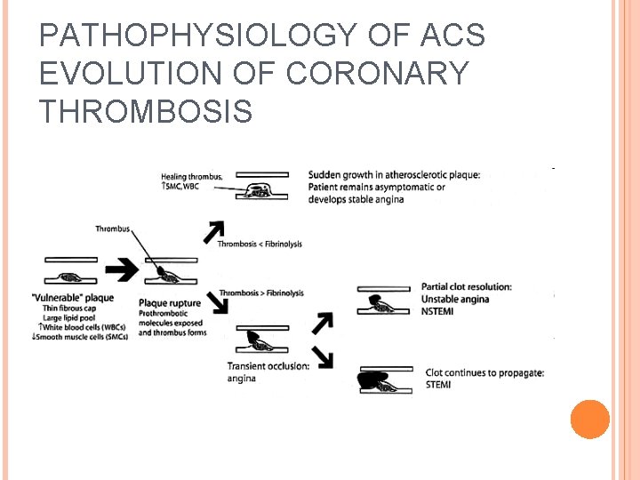 PATHOPHYSIOLOGY OF ACS EVOLUTION OF CORONARY THROMBOSIS 