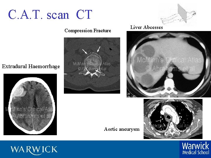 C. A. T. scan CT Compression Fracture Liver Abcesses Extradural Haemorrhage Aortic aneurysm 