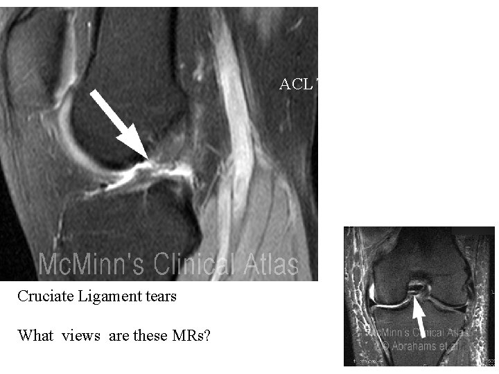 ACL TEAR Cruciate Ligament tears What views are these MRs? 