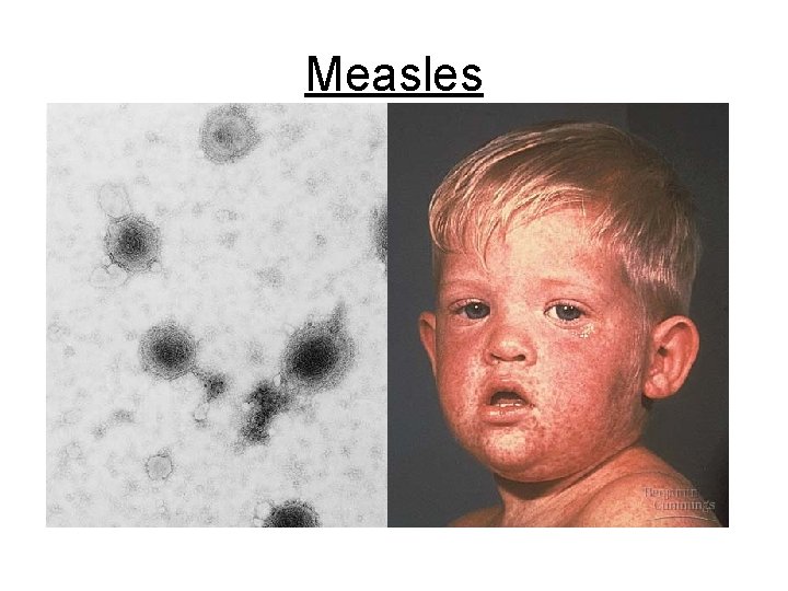 Measles 