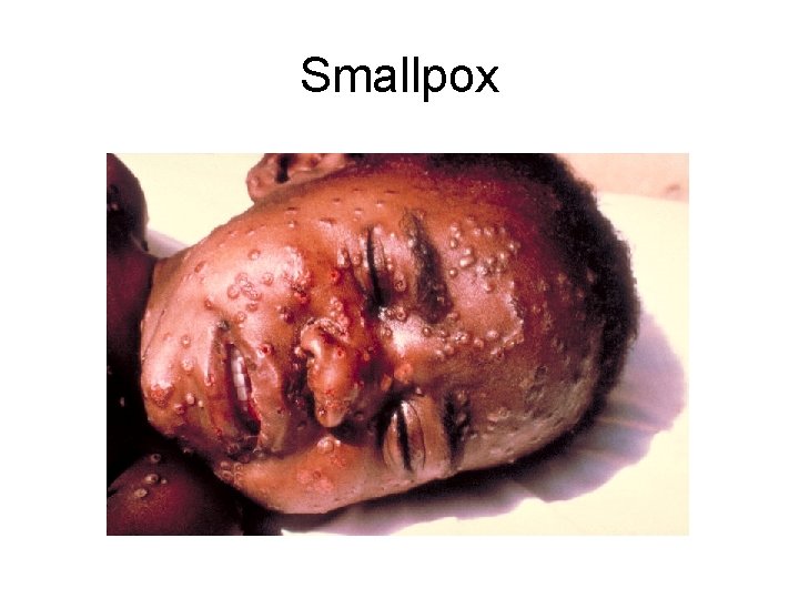 Smallpox 