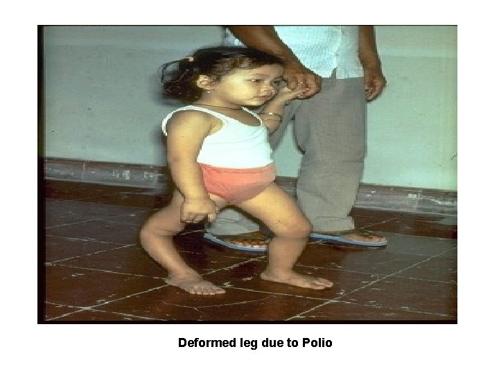Polio Deformed leg due to Polio 