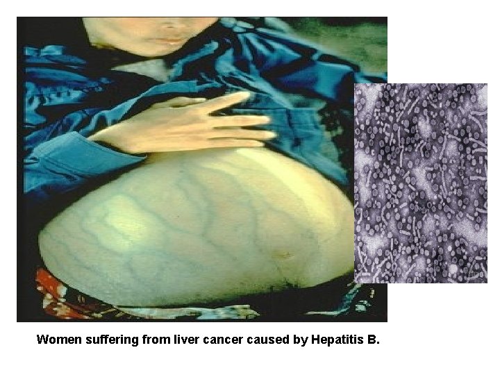 Women suffering from liver cancer caused by Hepatitis B. 