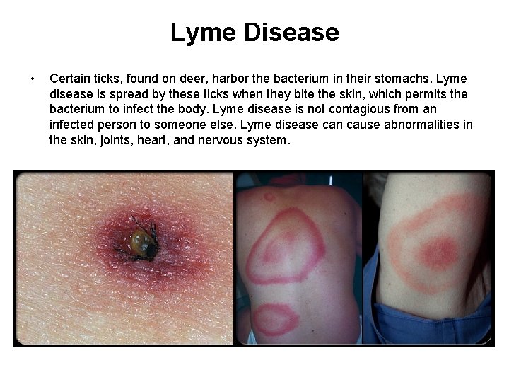 Lyme Disease • Certain ticks, found on deer, harbor the bacterium in their stomachs.