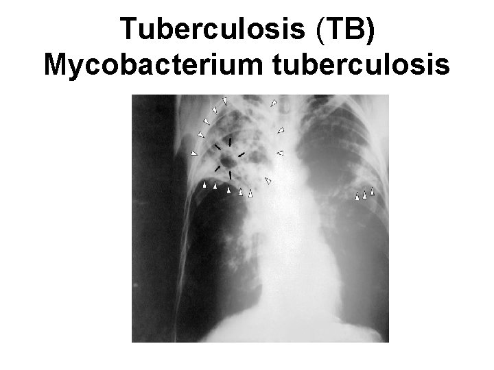 Tuberculosis (TB) Mycobacterium tuberculosis 